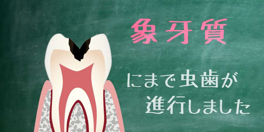 豆知識 虫歯なのに痛くない 虫歯で痛みが出る仕組みを分かりやすくまとめました 千早駅 陽だまり歯科