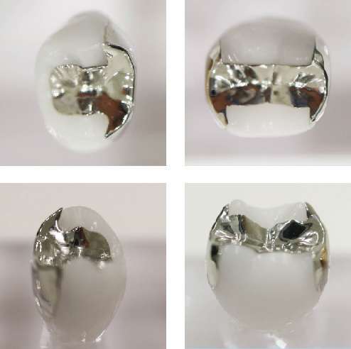 豆知識】銀歯に使われている金属は金パラと言います。えっ、銀歯なのに