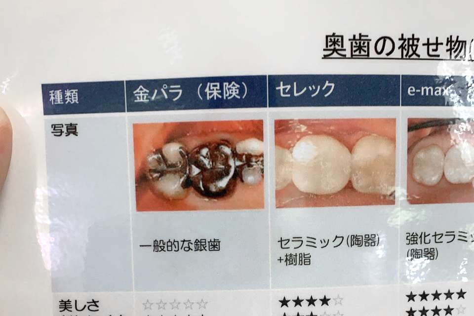 歯科技工 金属 金パラ - その他 歯科技工 金属 金パラ - その他