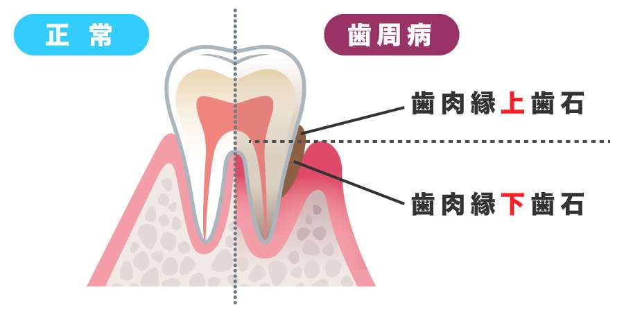 歯石取りだけのご相談 もちろん来てください 歯周病予防に歯石除去はとても大切です 千早駅 陽だまり歯科