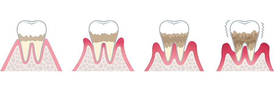 豆知識 歯槽膿漏と歯周病の違い ご存じですか 千早駅 陽だまり歯科